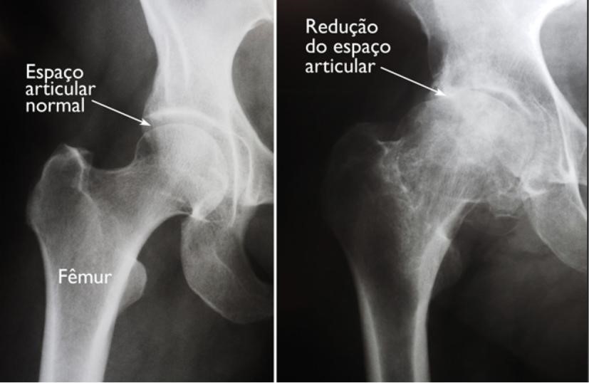 Artroplastia Total De Quadril Dr Leandro Calil