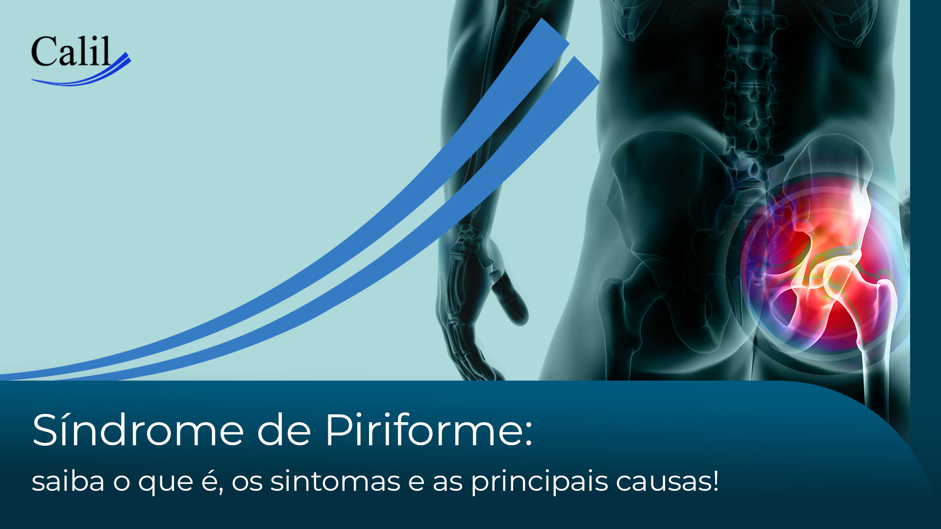 Síndrome de Piriforme: saiba o que é, os sintomas e as principais causas!