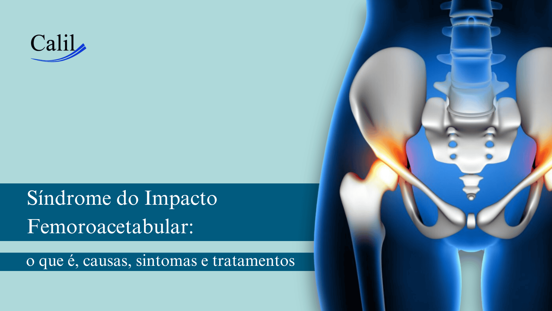 Síndrome do Impacto Femoroacetabular: o que é, causas, sintomas e ...