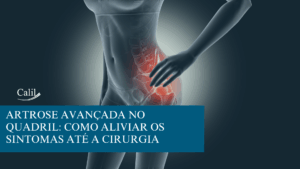 Artrose avançada no quadril